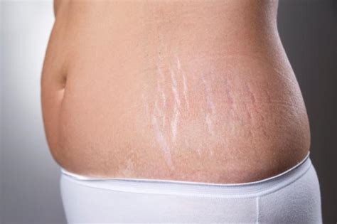 Stretch Mark Removal Treatments And Home Remedies