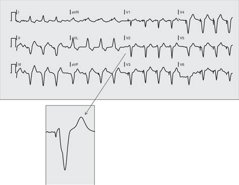 Electrocardiographic Differential Diagnosis of ST Segment Elevation | Anesthesia Key