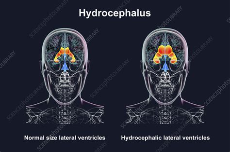 enlarged  normal lateral ventricles illustration stock image