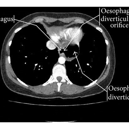 Corkscrew oesophagus. Barium swallow. | Download Scientific Diagram