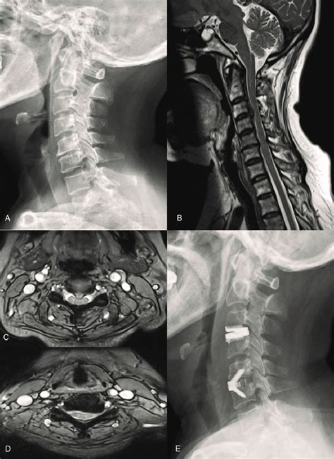 C3-4 Disc Herniations And C4-6 Disc Bulges, 42% OFF