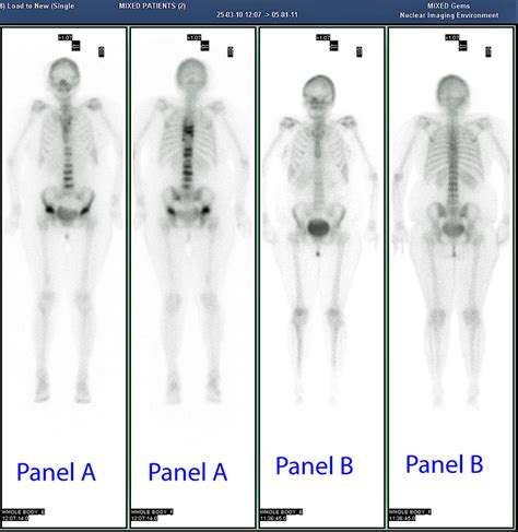 Whole Body M Tc Mdp Bone Scintigraphy Panel A Anterior And