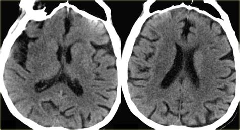 Stroke Ct Scan