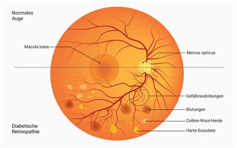 Diabetische Retinopathie Doccheck