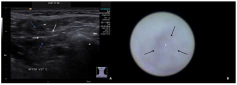 Jcm Free Full Text Ultrasound And Sialendoscopy Findings In