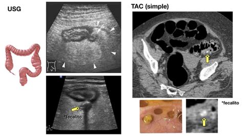 06 COMPLEMENTO Diverticulosis Y Enfermedad Diverticular Del Colon Pdf