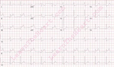 inferior posterior wall mi ecg  learntheheartcom