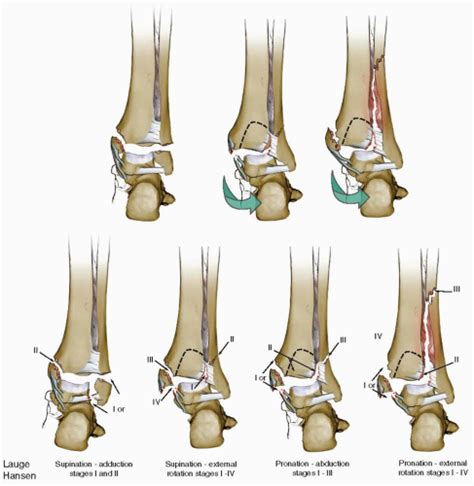 Ankle Fractures Musculoskeletal Key