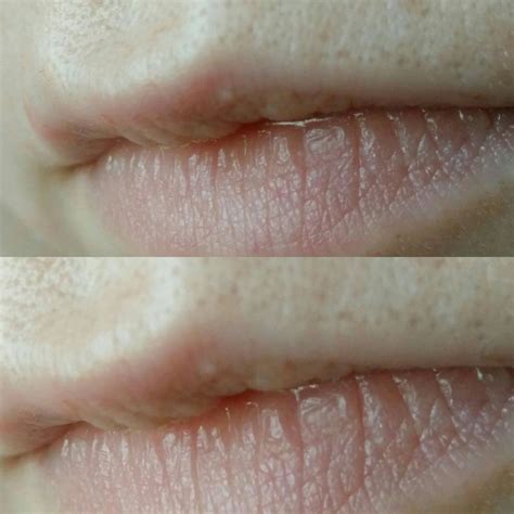 [Acne] Blackheads on upper lip line, need help/advice : SkincareAddiction