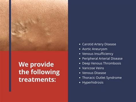 Ppt Varicose Veins Treatment In Los Angeles Encino Vascular Institute