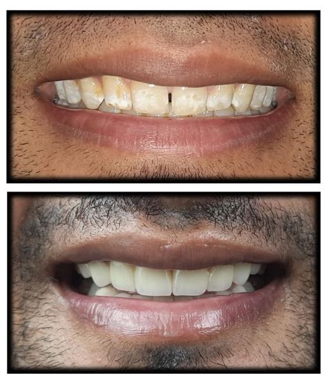 Smile Designing Mild Fluorosis Mohit Richardsons Plastic Surgery