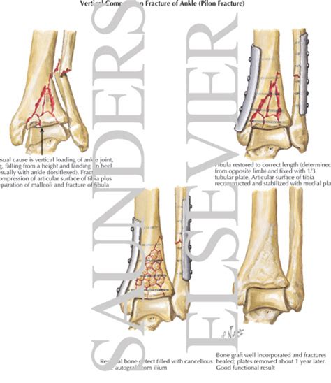 Pilon Tibial Fractures