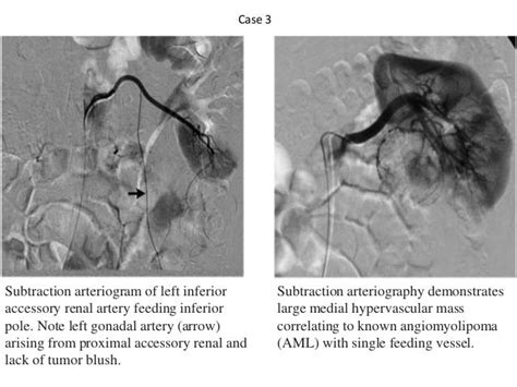 Renal Angiography