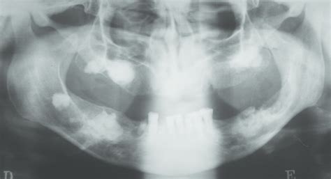 Diffuse Sclerosing Osteomyelitis