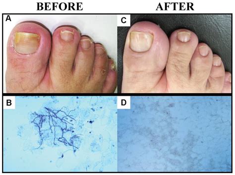 Frontiers Propolis Extract For Onychomycosis Topical Treatment From Bench To Clinic