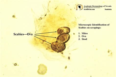 Parasitic Diseases: Scabies - Academic Dermatology of Nevada