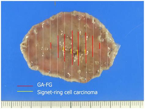 Gastric Adenocarcinoma Of Fundic Gland Type With Signet Ring Cell