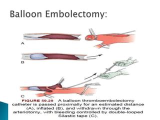 Arterial and venous embolectomy | PPT