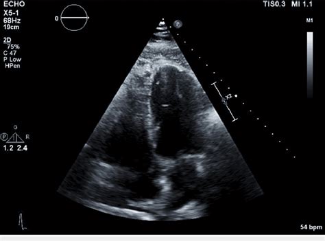 Transthoracic Echocardiogram Apical Four Chamber View Download