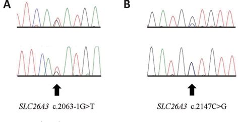Figure 1 from Novel Mutation of SLC26A3 Gene Observed in Congenital ...