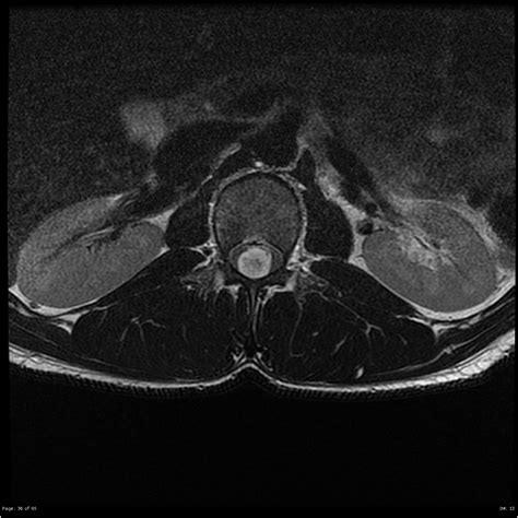 Myxopapillary Ependymoma Image