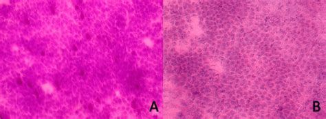 Conjunctival Impression Cytology Of The Subject Patients A Normal