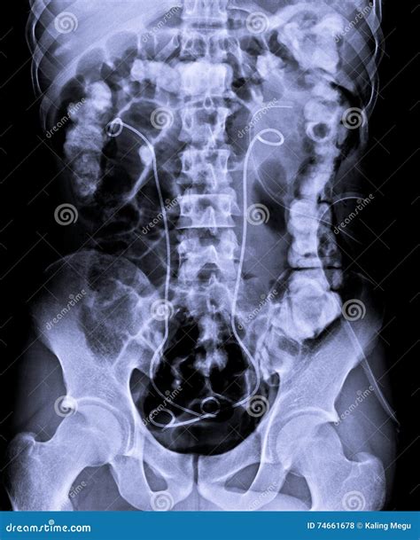 X Ray Abdomen Stock Photo | CartoonDealer.com #74661678