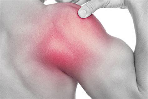 Frozen Shoulder Kayaykalp Physiotherapy