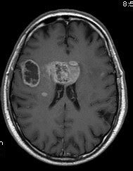 Multicentric Glioblastoma Multiforme MRI Sumer S Radiology Blog