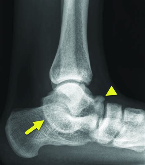 talocalcaneal coalition applied radiology