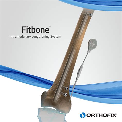 Cédric Bagnoud On Linkedin Fitbone Intramedullary Lengthening Nail