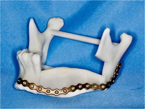 Mandibular Reconstruction Using Iliac Flap Based On Occlusion Driven