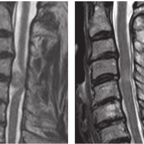 Case 22 A Preoperative T2 Weighted MRI Of The Cervical Spine