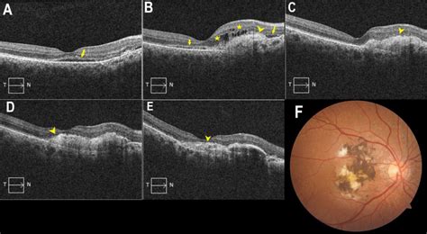 A Oct Image Of The Macula In The Right Eye At First Visit Subretinal