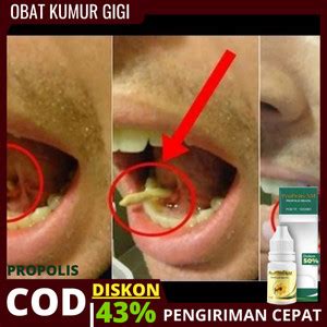 Jual OBAT KUMUR PERONTOK ULAT GIGI PENGHILANG ULAT GIGI GIGI