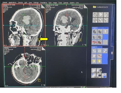 Figure From Analysis Of Computed Tomography Dose Index Ctdi And