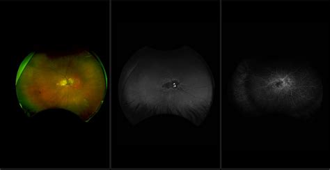 Angioid Streaks Case Study