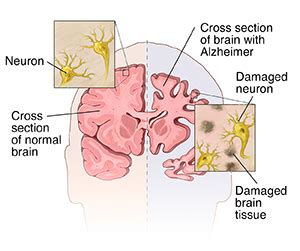 Alzheimer Disease Health Encyclopedia University Of Rochester