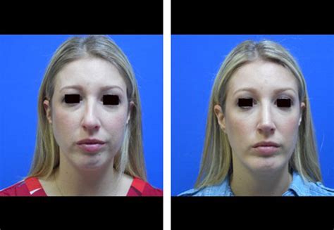 Chin Augmentation Procedure Houston Chin Implants Cilento Facial