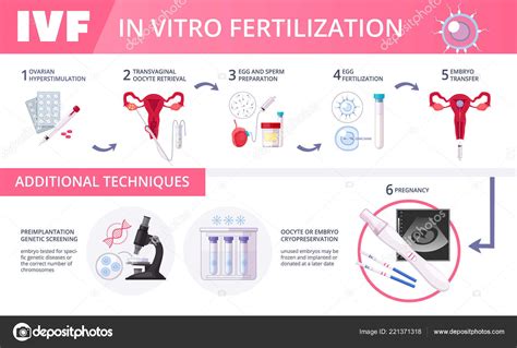 Fertilización In Vitro Ivf Infografías Planas Vector Gráfico Vectorial