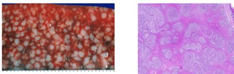 neoplasms II Flashcards | Quizlet