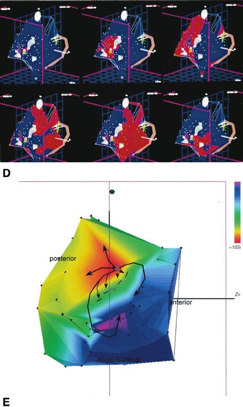 Continued From Previous Page D Propagation Map Of Atrial