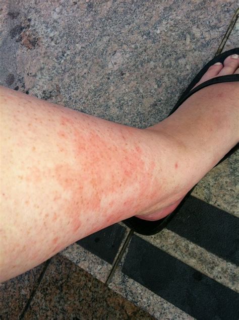 Leg Rashes In Adults Vasculitis Tell The It Because Few Bumps On Mostly Area On Leg Rash