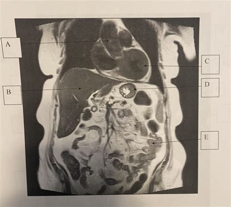 MRI Abdomen Anatomy 1 Diagram | Quizlet