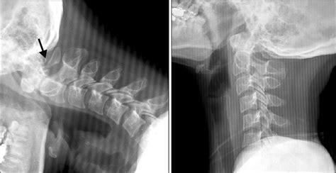 Posterior Arch Fracture