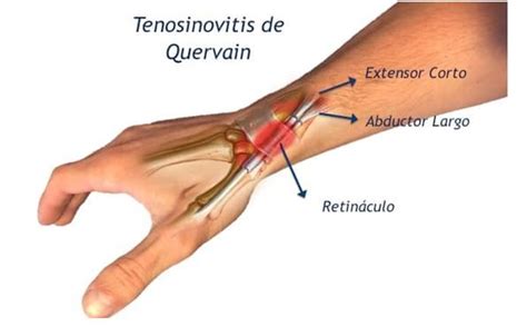 Tuber A Fingir Expandir Tendinitis Cubital De Mu Eca Vender Partido