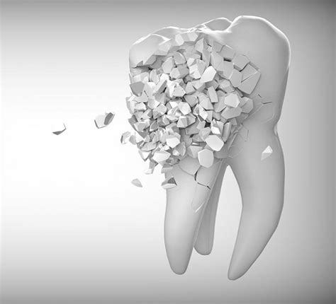 surf city dentist    cavity
