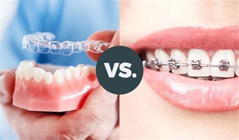 Braces Vs Aligners Choosing The Right Orthodontic Treatment For Your