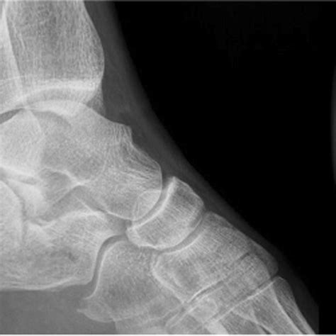 Case 1 Preoperative Radiographs Radiographs Left Calcaneus Lateral A