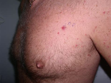 Papules Lymphoma